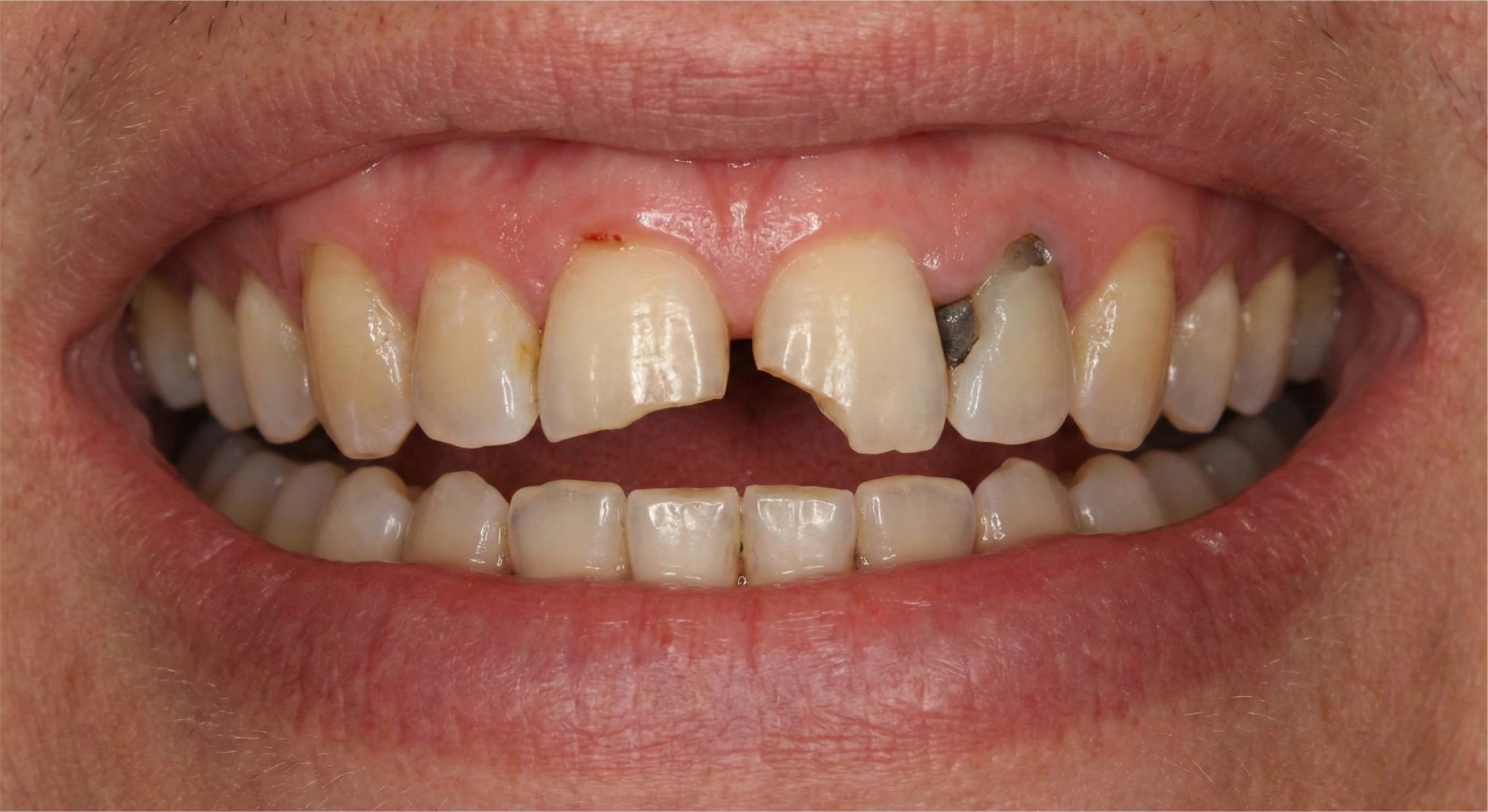 Before — Zirconia Crowns